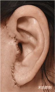 疤痕恢复过程 2