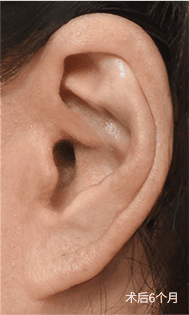 疤痕恢复过程 3