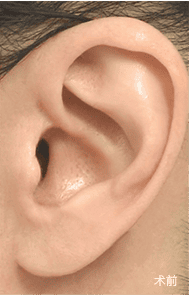 疤痕恢复过程 1