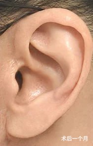 疤痕恢复过程 2