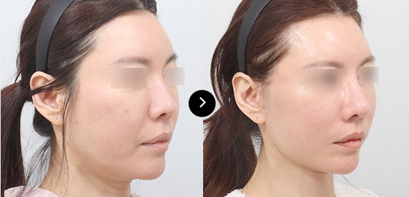 半脸SMAS提升 이미지 1