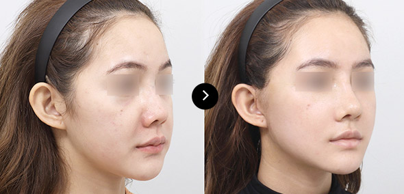 半脸SMAS提升 이미지 3