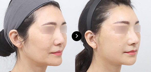 半脸SMAS提升 이미지 4