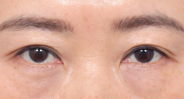 适当的调节肌肉固定强度
6个月后无疤痕弧度