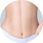 Liposuction result 3